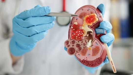 Chronic Kidney Disease