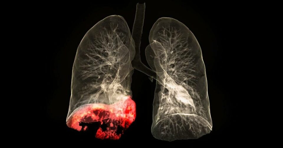 Lung Cancer